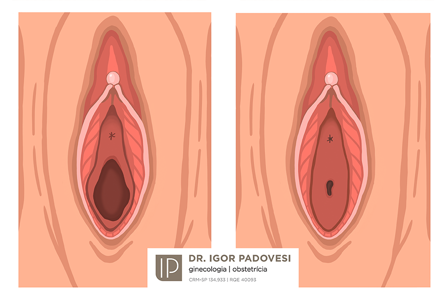 Himenoplastia sp especialista