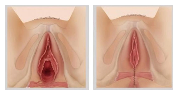 perineoplastia sp especialista